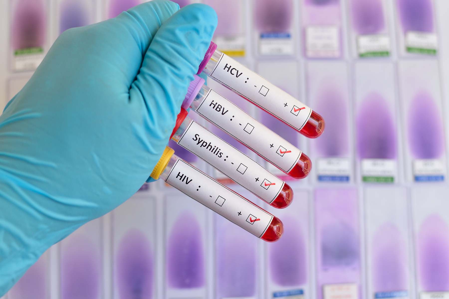 A doctor's gloved hand holding test tubes containing blood samples for sexually transmitted infections tests.